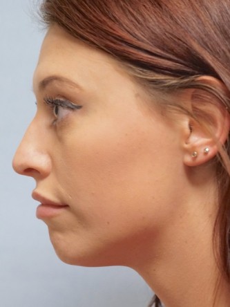 Cupid’s Bow Enhancement by Juvederm* — After