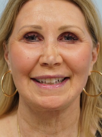 Endoscopic Browlift, Facial Fat Graft, Full Facelift, Fractional CO2 Laser* — After