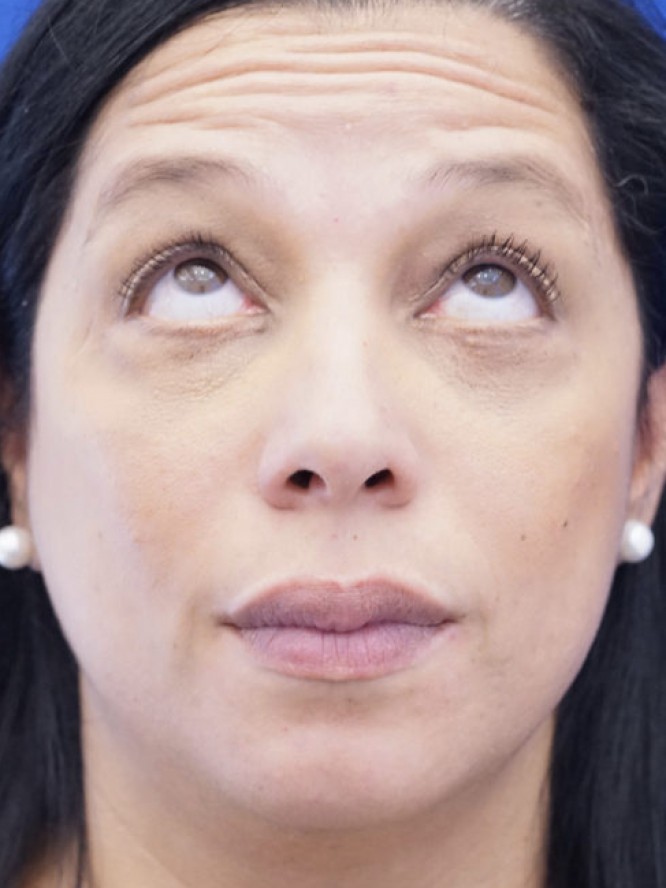 Lower Lid Fat Reposition — After