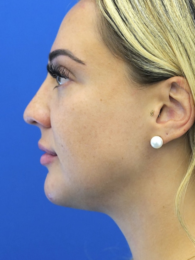 Lower Facial Rejuvenation — After