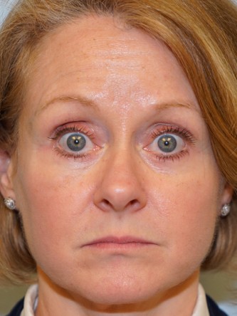 Lower Eyelid Excess Fat Pad1* — After