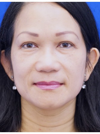 Asian Eyelid Crease Elevation — After
