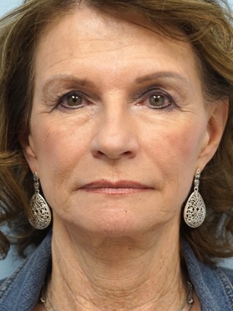 Face/Necklift, Aging Eyelid Surgery, Facial Fat Graft, Laser Resurfacing* — Before