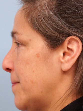Nasal Septal Perforation2* — Before