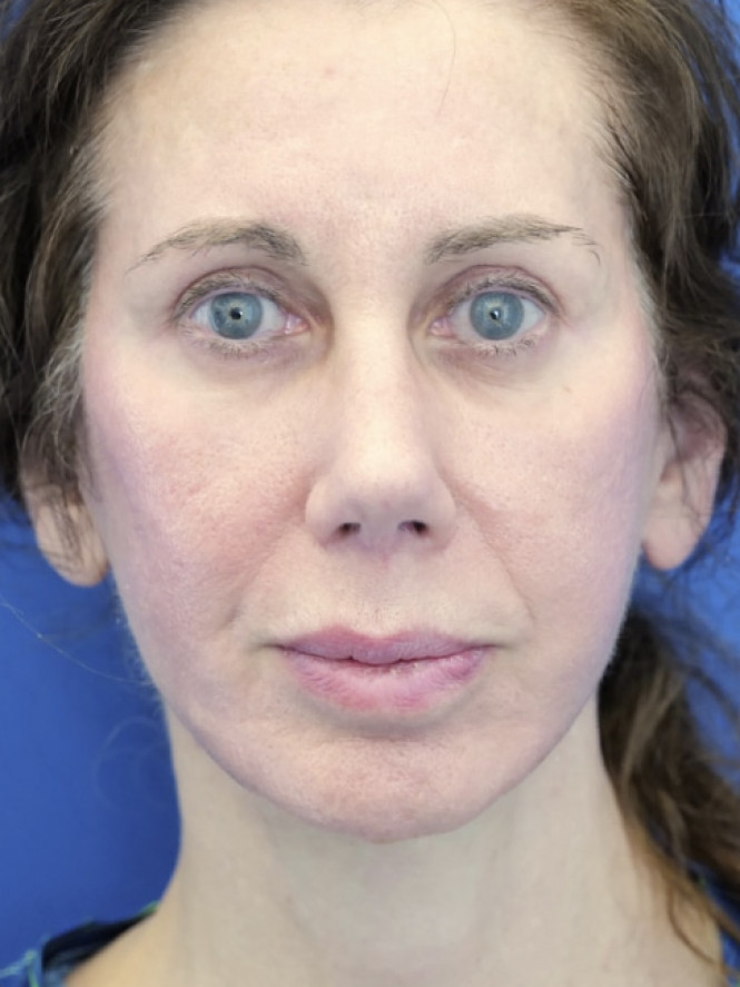 Natural Result — After