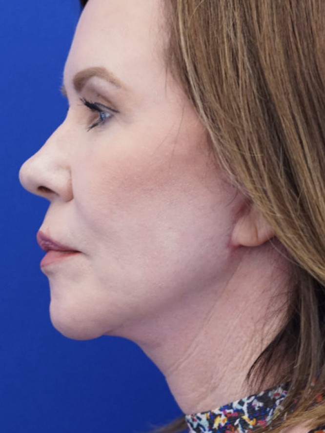 Secondary Lift and Facial Fat Grafting — After