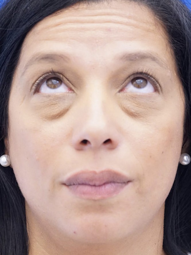 Lower Lid Fat Reposition — Before