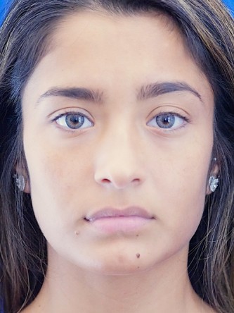 Voluptuous Lip Enhancement* — Before