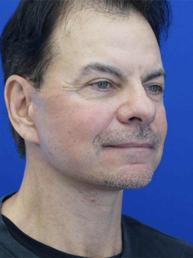 Neck Loose Skin — After