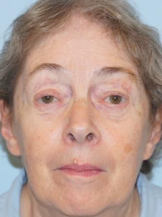 Visual Field Deficit – Eyelid Ptosis3* — Before