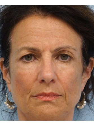 Upper Eyelid Skin Excess1* — Before