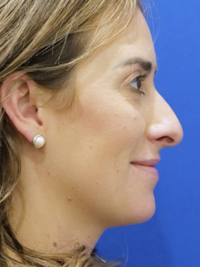 Preservation Rhinoplasty — Before