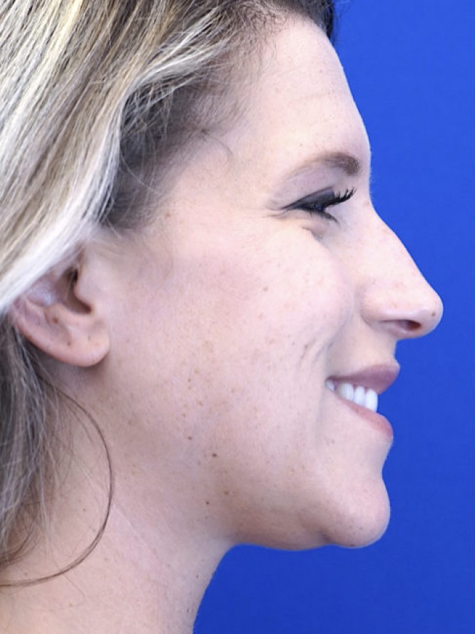 Aesthetic Nasal Profile — Before