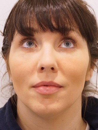 Under Eye Shadow* — After