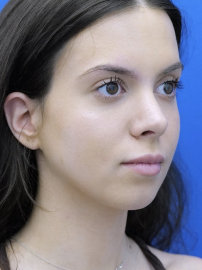 Preservation Rhinoplasty2 — After