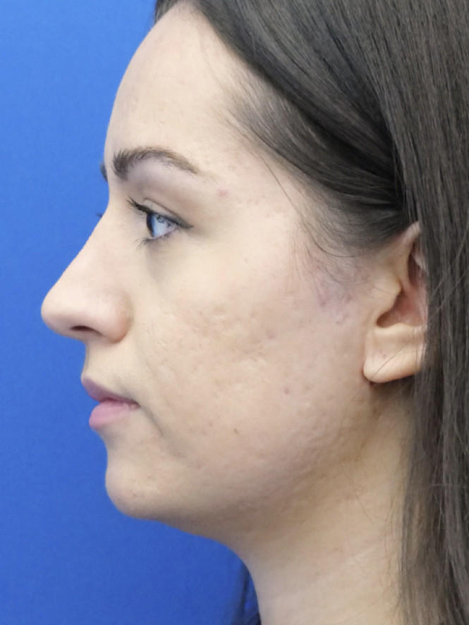 Dorsal Hump Removal — After