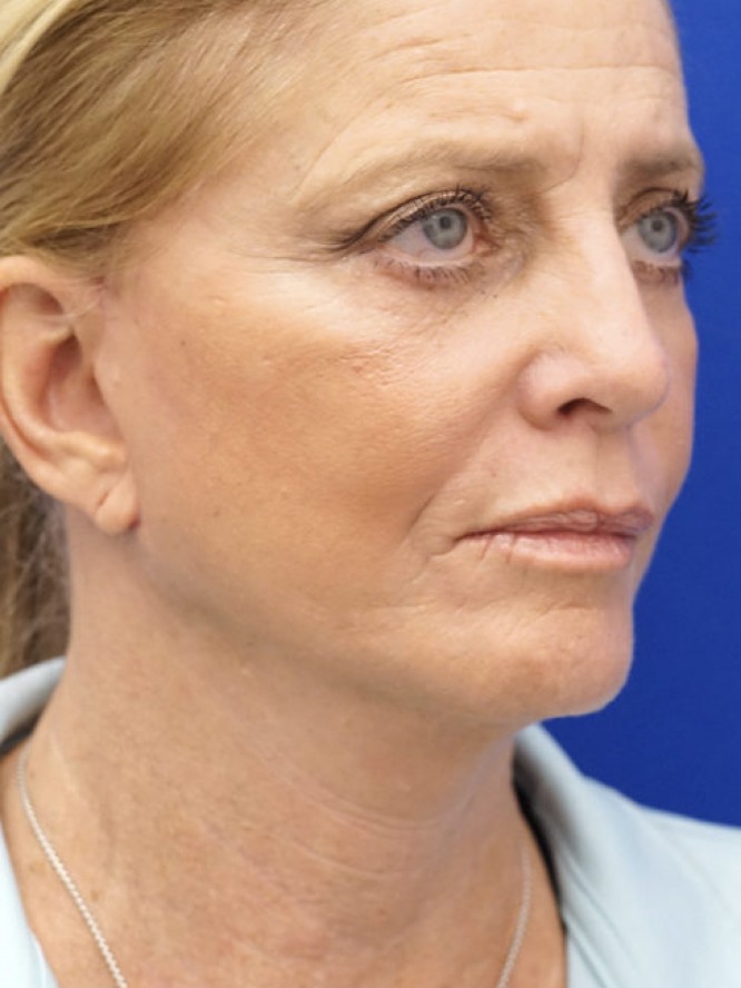 Deep Plane Lower Facelift — After