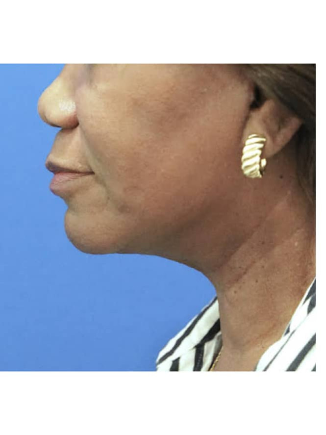 Necklift with Platysmaplasty — After