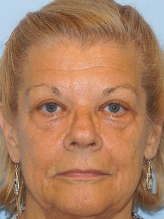 Upper Eyelid Droop and Skin Excess* — After