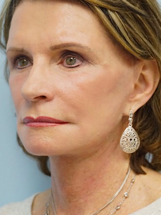 Face/Necklift, Aging Eyelid Surgery, Facial Fat Graft, Laser Resurfacing* — After