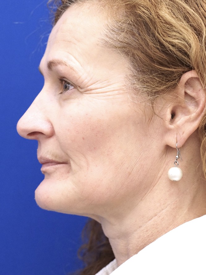 Prominent Chin — Before