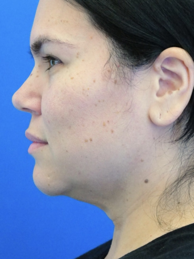 Jaw Line Etching — Before