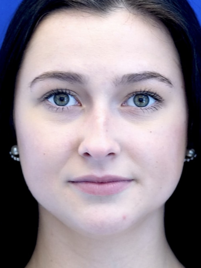 Soften Nasal Bridge — Before