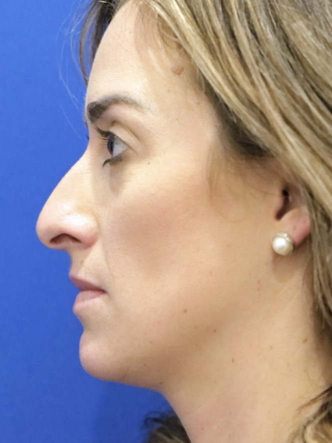 Preservation Rhinoplasty — Before