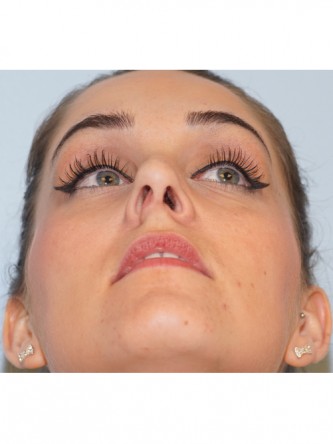 Nasal Septal Perforation1* — After