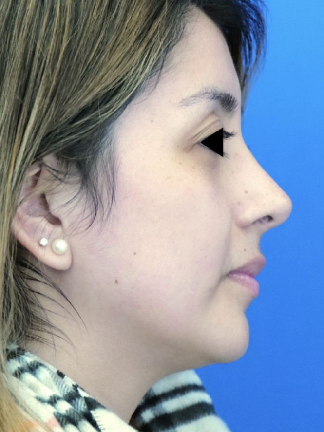 Minimize Tip Droop When Smiling — After