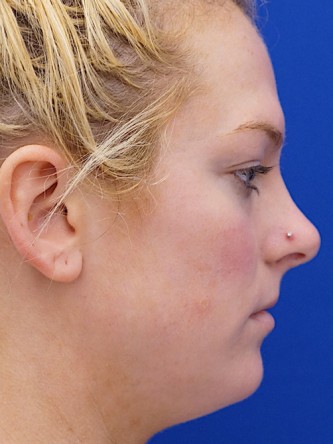Restylane Silk Equalizes Lip Volume* — Before