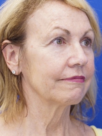 Deep Plane Lift and Superficial Laser — Before