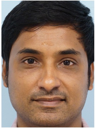 Restylane to Tear Trough – Under Eye* — Before