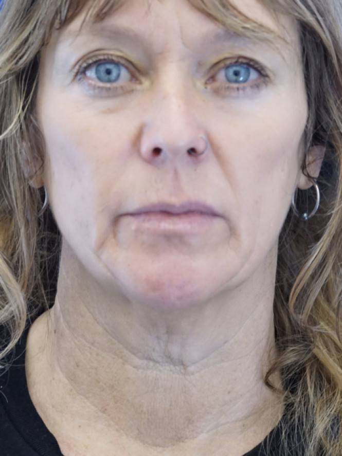 Fantastic Facial Profile — Before
