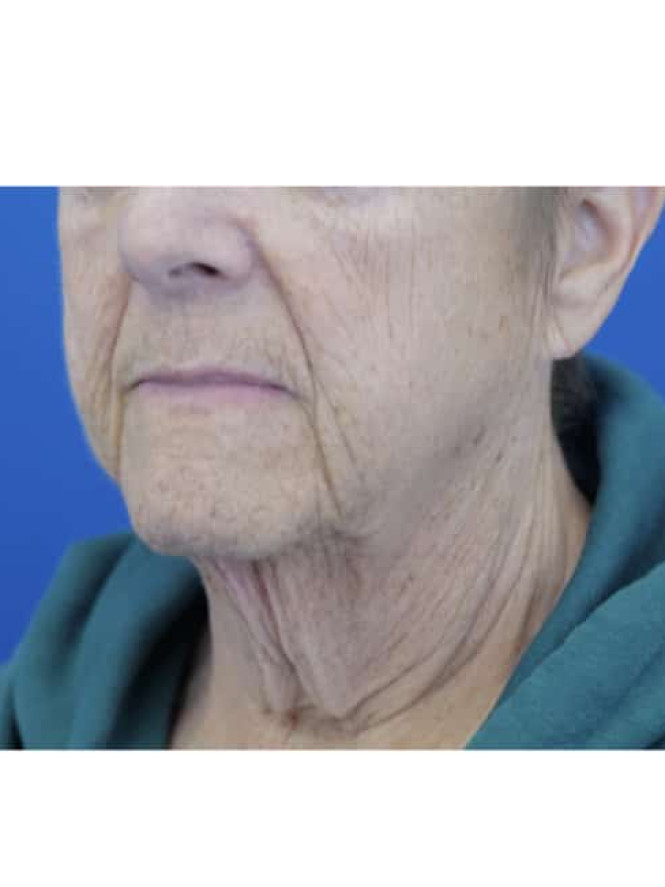 Neck Tissue Laxity — Before