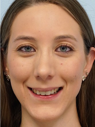 Nasal Hump Endonasal Rhinoplasty* — After