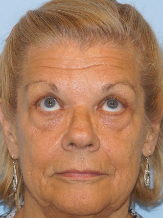 Upper Eyelid Droop and Skin Excess* — After