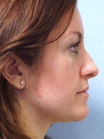 Boxy Tip Endonasal Rhinoplasty* — Before