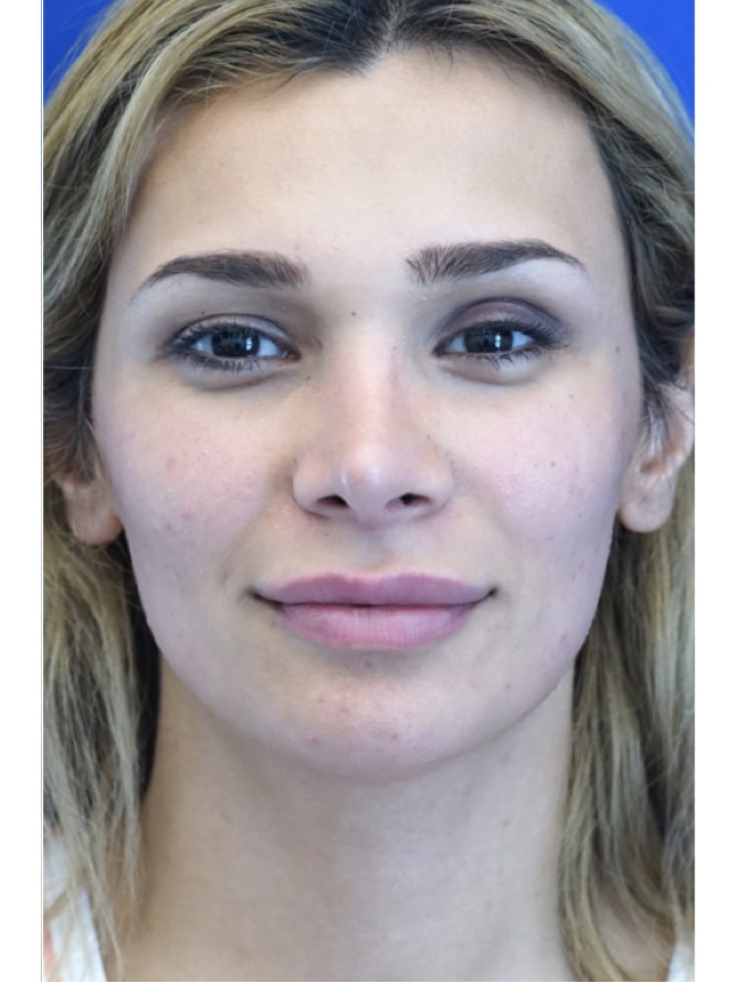 Nasal Deviation and Dainty Tip — After