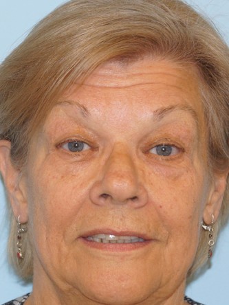 Upper Eyelid Droop and Skin Excess* — Before