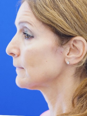 Mild Neck Skin Laxity — Before