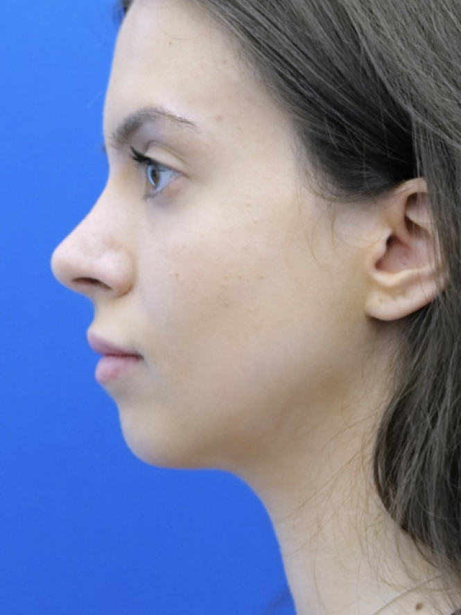 Preservation Rhinoplasty2 — After