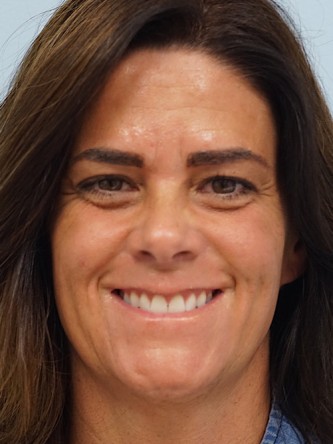 Glabellar Botox and Filler* — Before