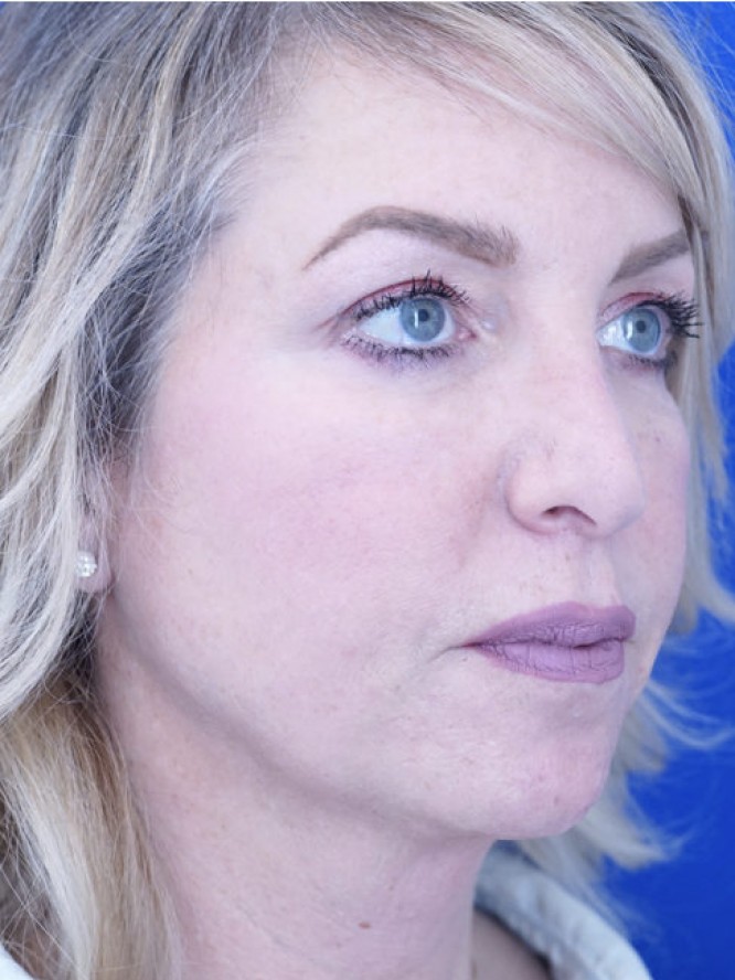 Tip Ptosis — Before