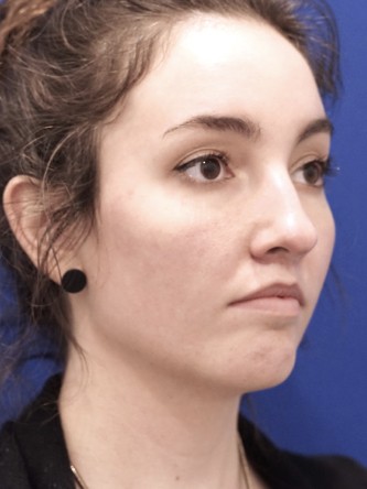 Upper Lip Fullness* — After