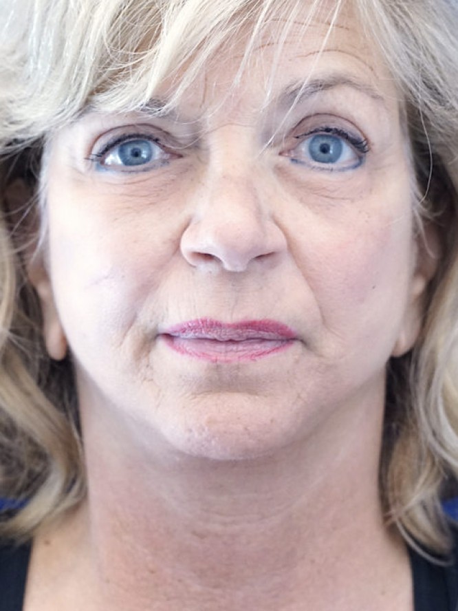 Jowls and Loose Neck Skin — After
