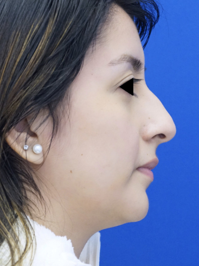 Minimize Tip Droop When Smiling — Before