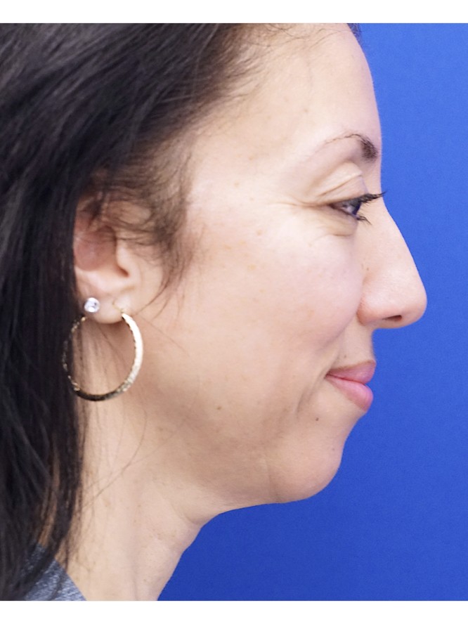 Natural Result — Before