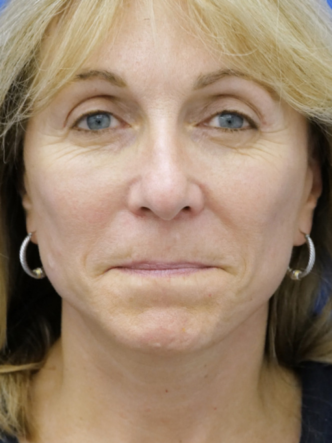 Hairline Browlift — After