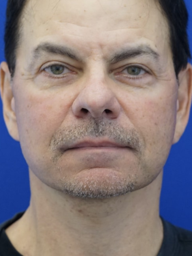 Neck Loose Skin — After